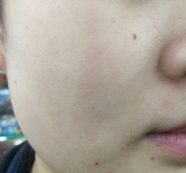 角质层薄冬天脸容易红怎么保护,皮肤容易泛红角质层薄怎么护理
