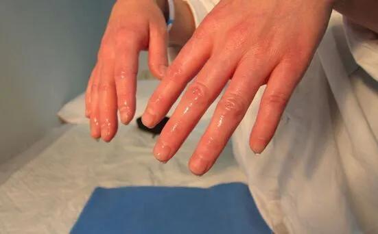 手汗多是不是大病的前兆,手汗流不止是什么原因