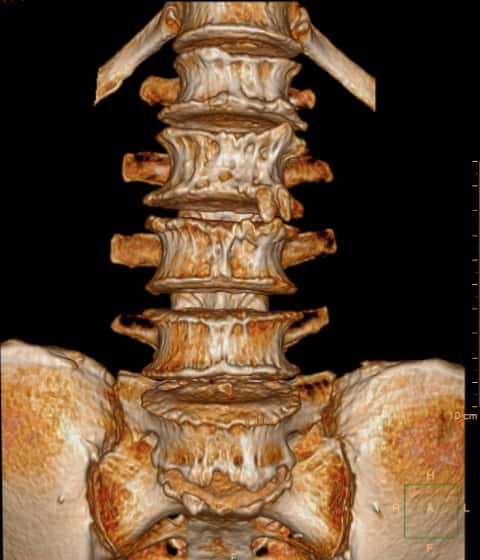 腰椎管狭窄症手术好么,腰椎管狭窄手术和保守治疗哪个好