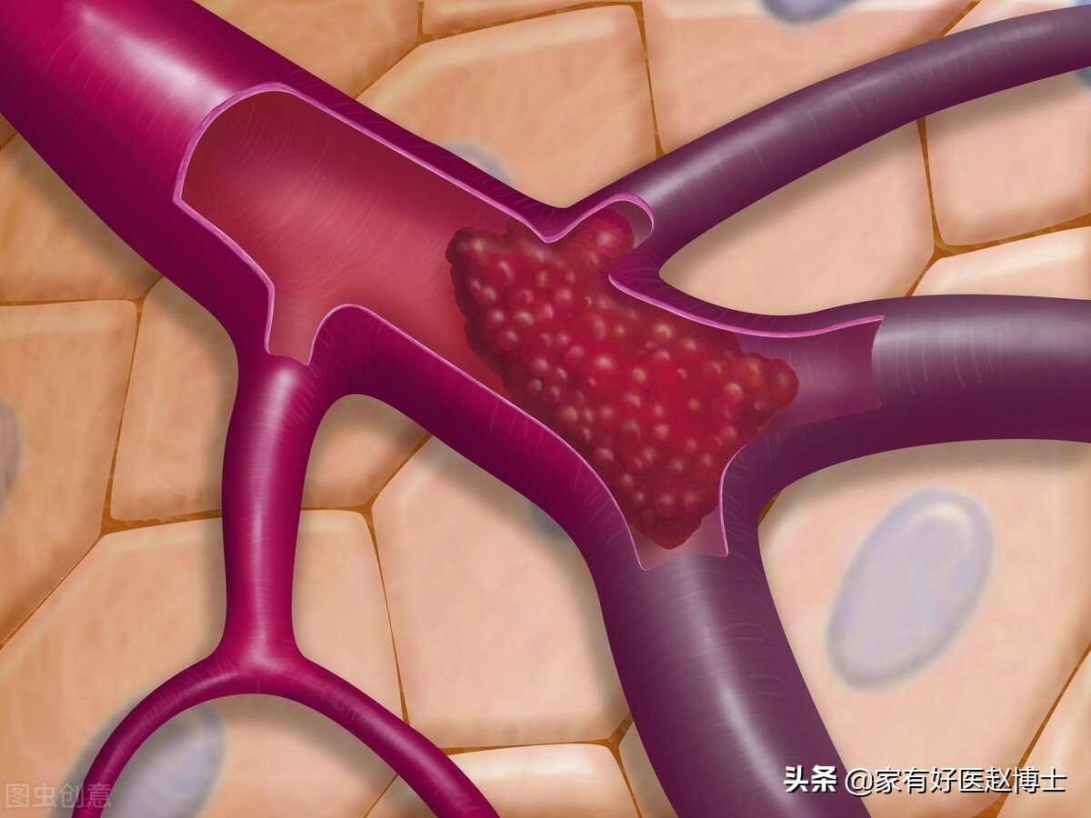 脂蛋白a升高有药治吗,脂蛋白a升高原因