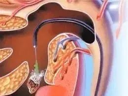 钬激光肾结石无创手术,钬激光碎石后结石还没出来怎么办