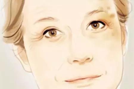 医生建议怎么祛斑,医生教你如何祛斑