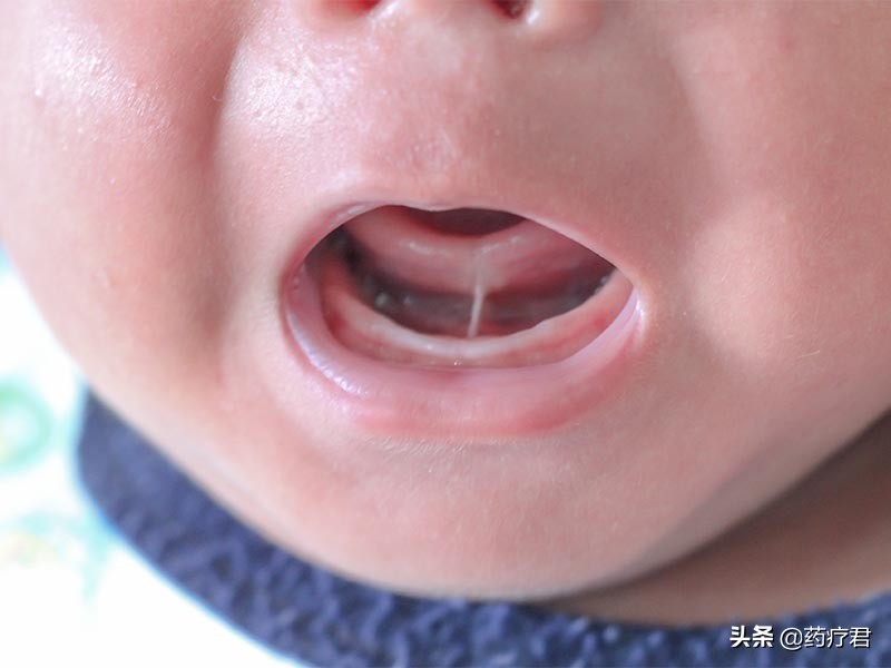 宝宝舌筋短需要剪吗,婴儿舌筋短什么时候剪最合适