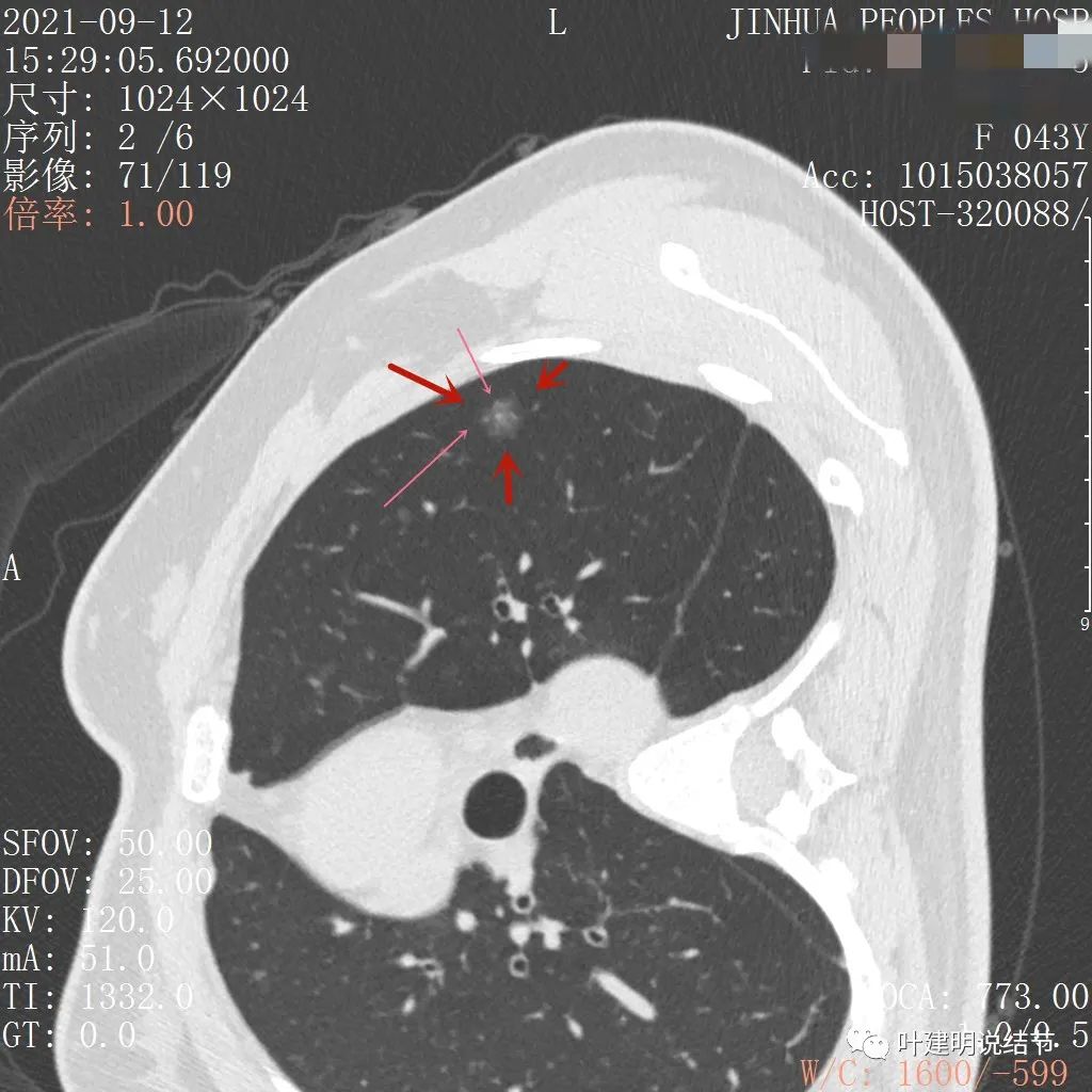 怎样从病理报告看是不是原位癌,原位腺癌切除子宫要开刀吗