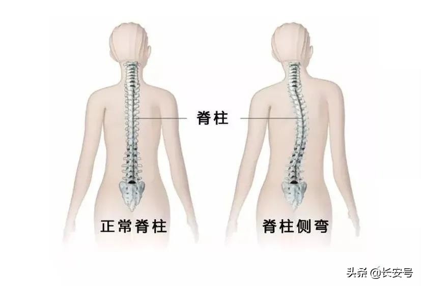 「医疗科普」关注儿童青少年脊柱侧弯