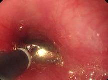 异物进入喉咙用什么方法施救,异物误入气管急救方法叫什么