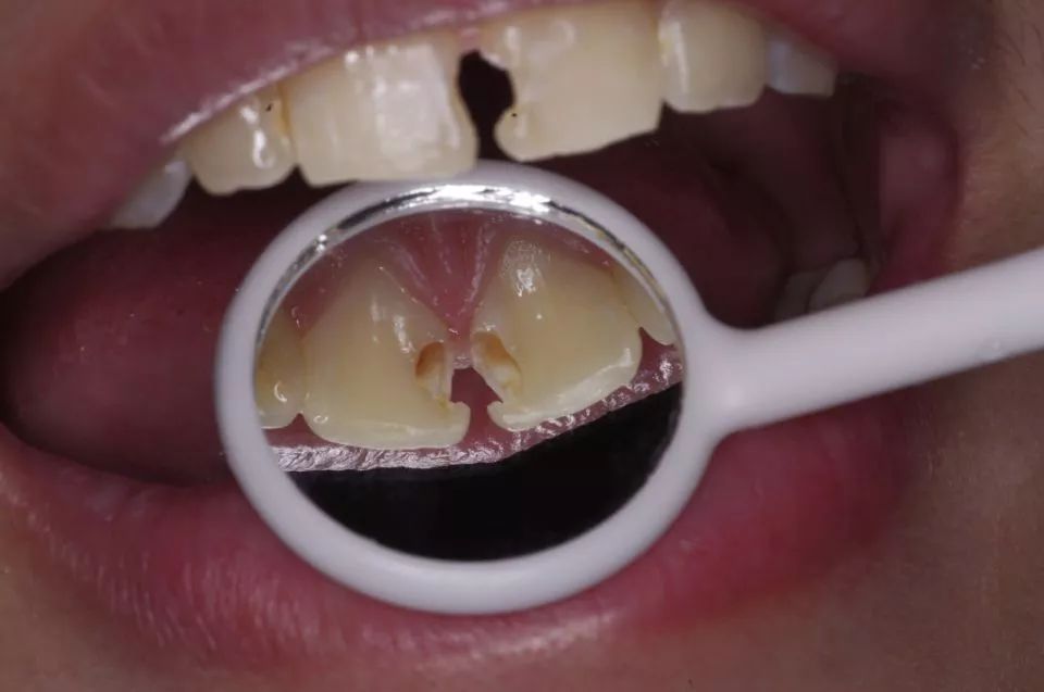 蛀牙总是一颗接着一颗？看来你不只是需要补牙了