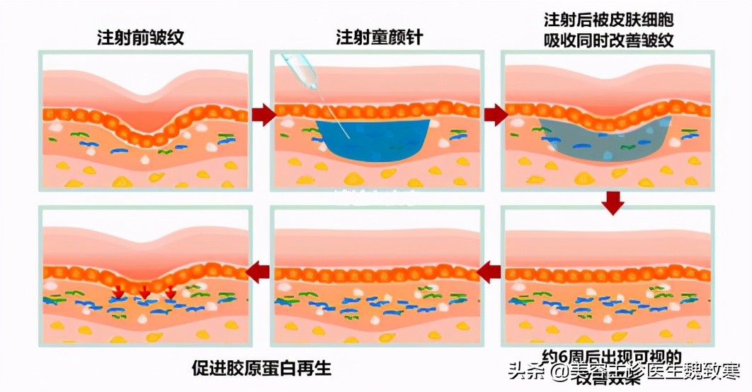 魏致寒：“童颜针到底是什么？最全的科普文章！”