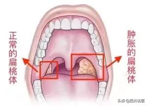 孩子反复发烧中医,中医治小孩反复发烧最好的方法