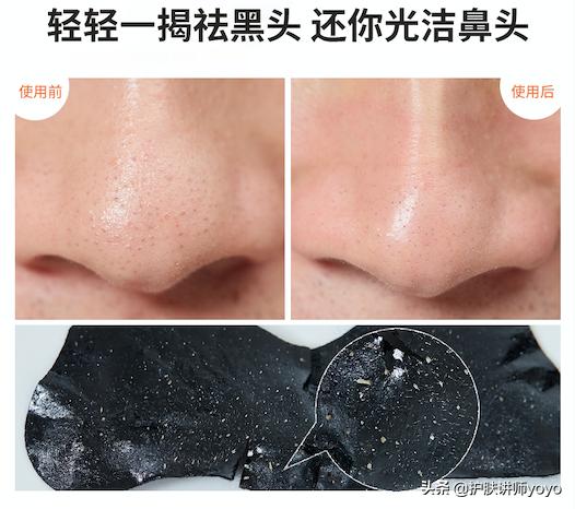 去黑头护肤正确过程,挤黑头之后怎么护肤