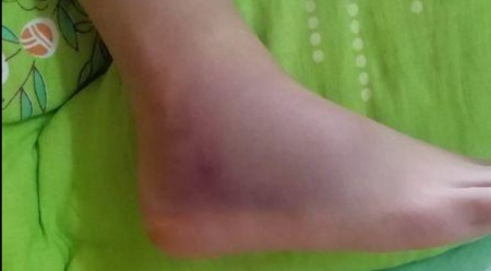 脚踝扭伤一个月了还肿疼痛正常吗,脚踝扭伤肿胀疼痛用什么药