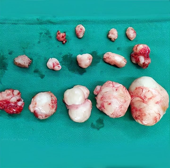 月经多是长了瘤吗,子宫肌瘤是福还是祸