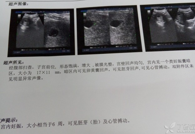 终止妊娠是药流还是人流,宫内妊娠48天选择什么流产术