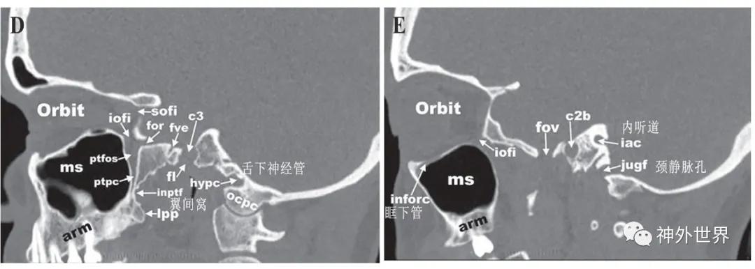 颅底骨折合并脑脊液漏伤情鉴定,颅底骨折伴脑脊液漏右眼眶骨折