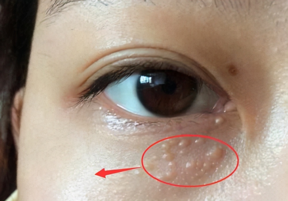 脸上长脂肪粒怎么办快速消除,脸上长了脂肪粒怎么去除小窍门