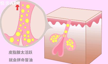 出油毛孔粗大冒痘暗沉怎么改善,男生脸部出油毛孔粗大改善方法