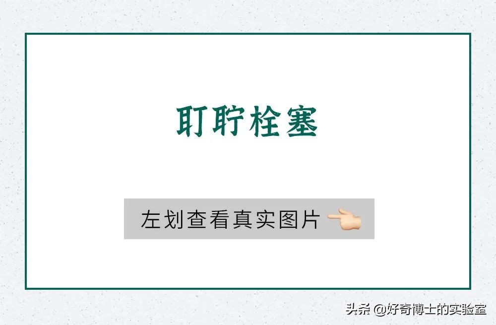 看看8年没有掏耳屎是什么样子,十年不掏耳屎你耳朵有多脏