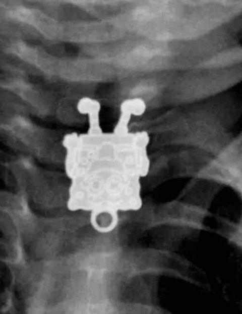 不作死就不会死,看看这些被人类搞进身体里的异物