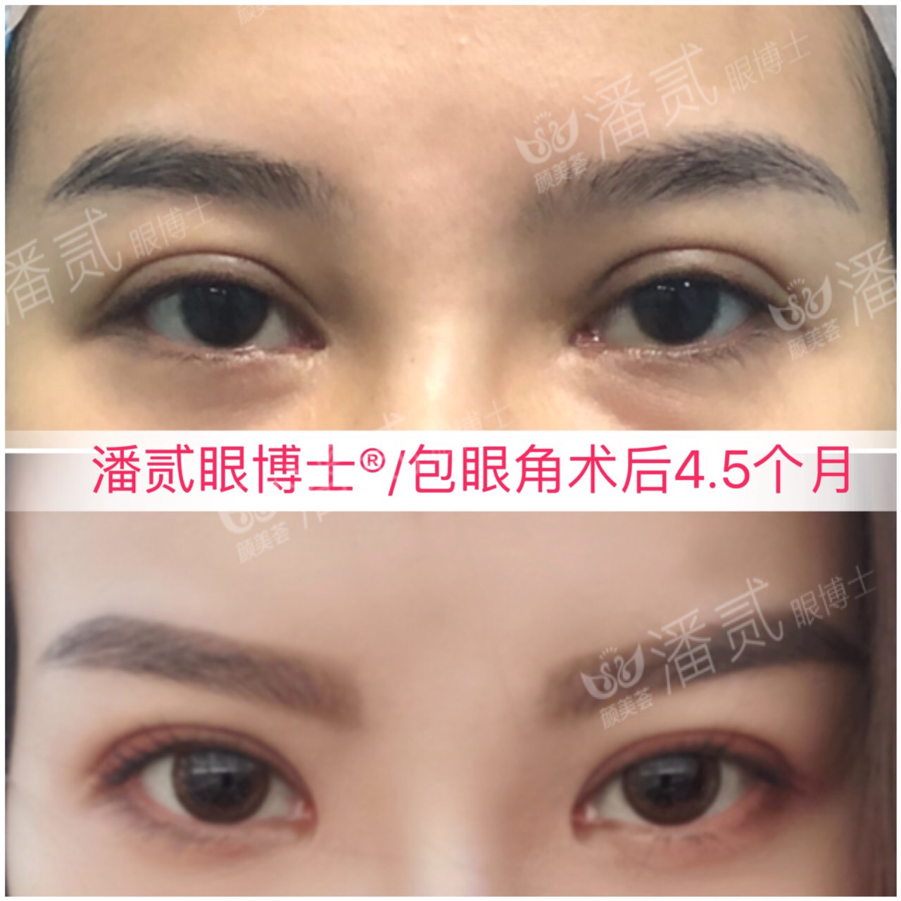 开内眼角会留疤的照片,开内眼角的疤痕变白色了怎么办