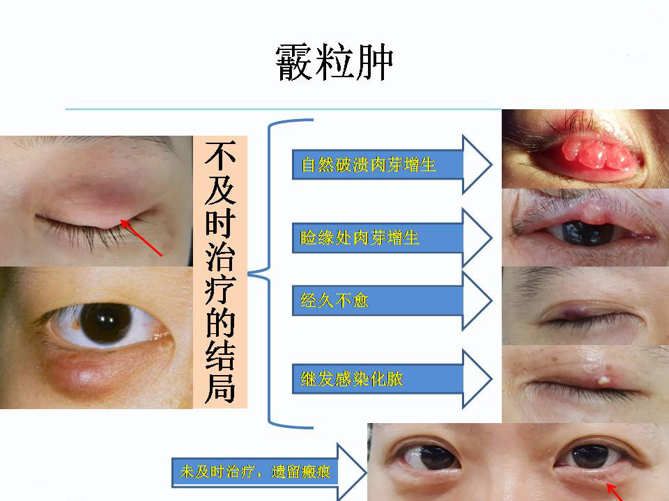 下眼睑黑眼圈特别严重是怎么回事,黑眼圈严重眼袋浮肿是什么原因
