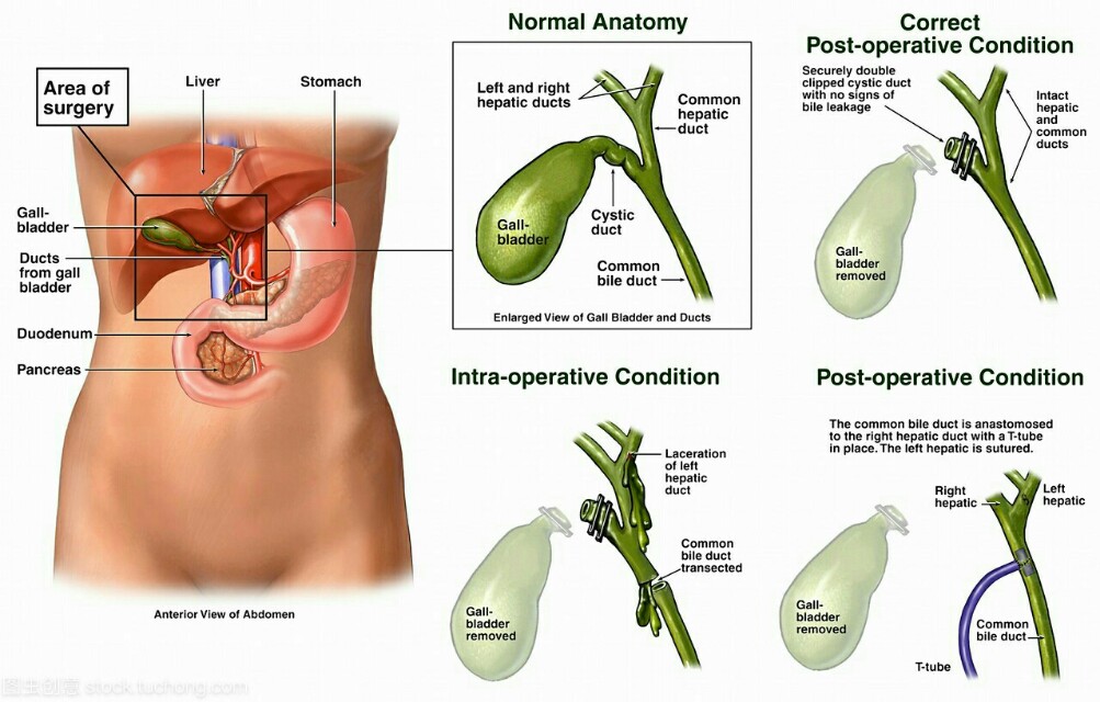 胆囊切除增加大肠癌的风险吗,胆囊切除后会增加肠癌风险吗