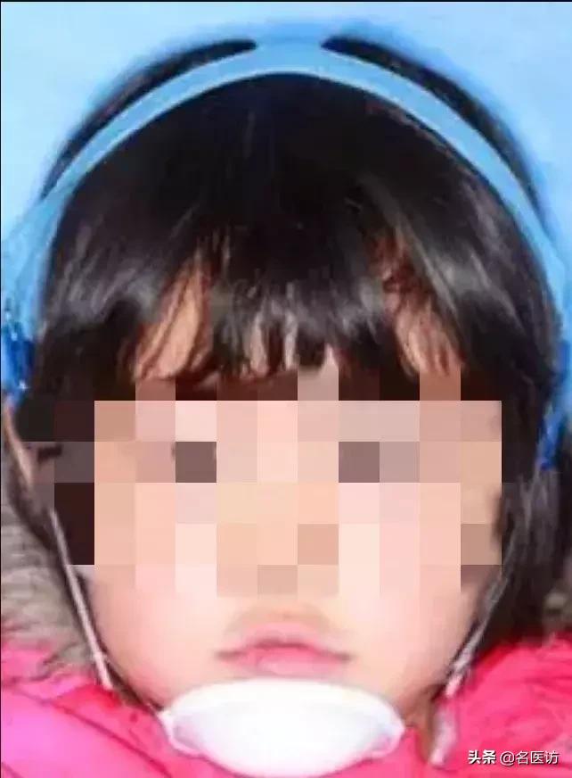 地包天早期矫正最佳时间,地包天最佳矫正时间及方法