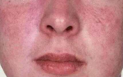 春天皮肤敏感泛红刺痛要怎么护肤,春季皮肤过敏泛红怎么护肤