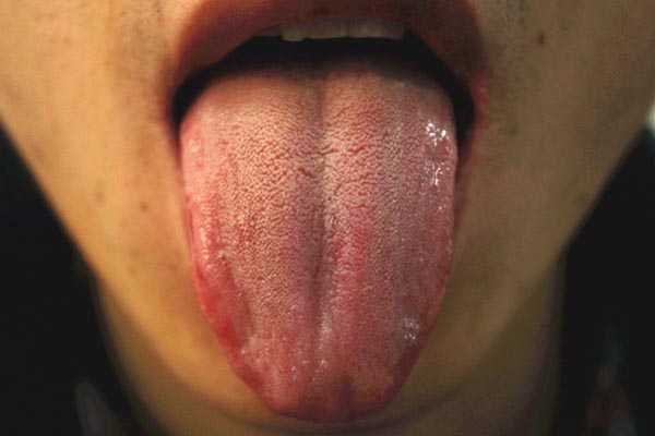 舌苔为什么会变色,舌苔为啥变厚