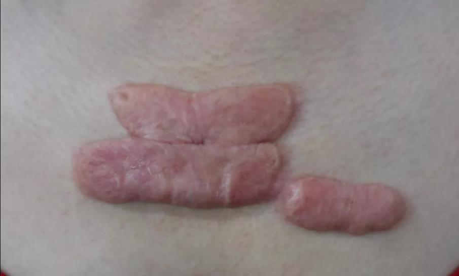 疤痕增生变软了是快好了吗,增生疤变软