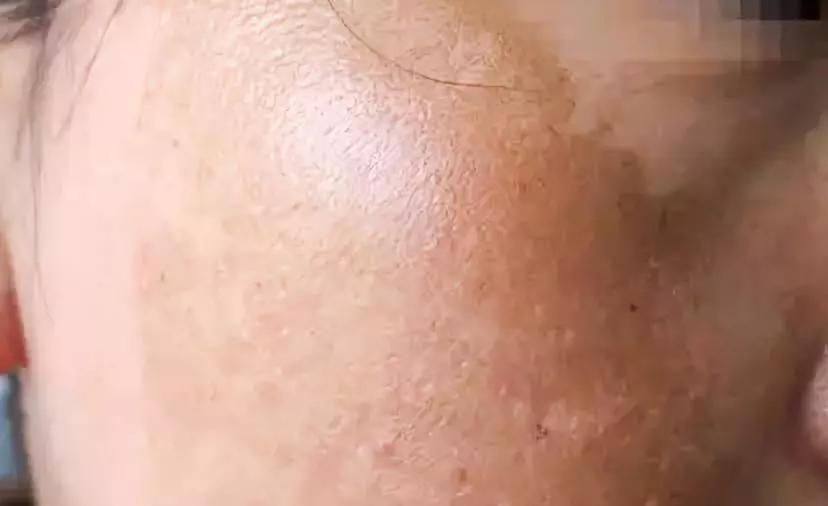 褐斑怎么治疗最有效,有什么好方法淡黄褐斑