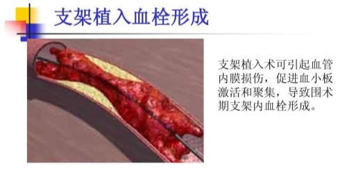 做了心脏造影后手腕刀口有渗血,做了心脏造影后伤口多少天能见水