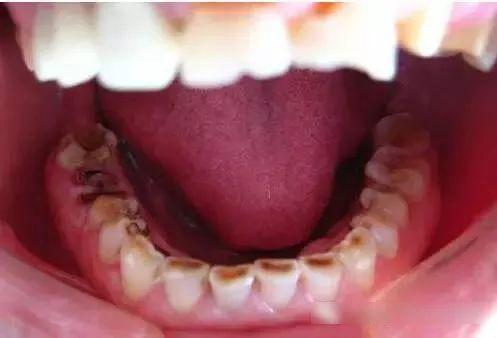 大连齿医生口腔科普牙齿磨耗,你敢懈怠吗?