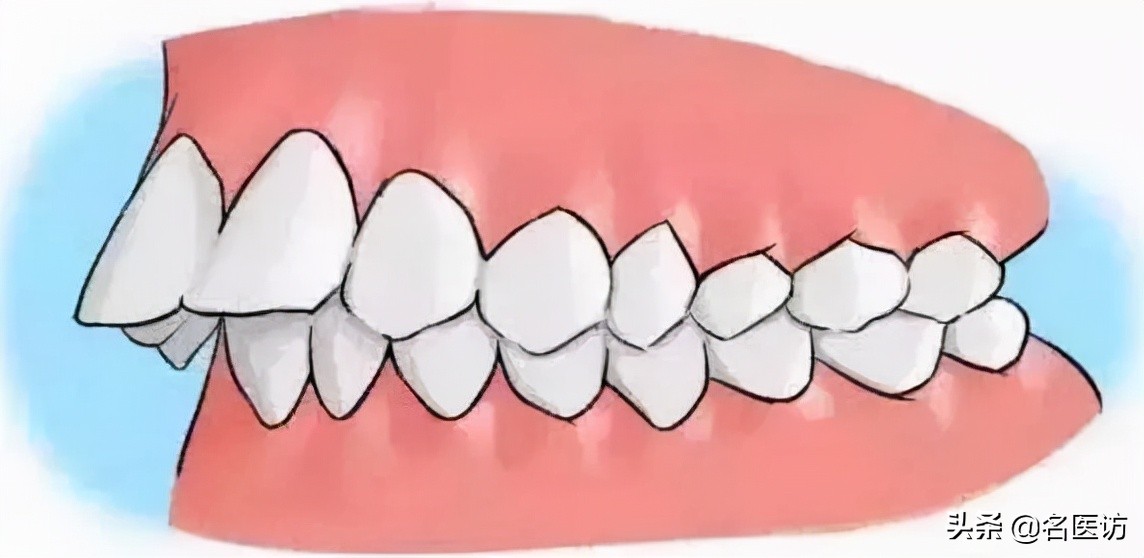 矫正牙齿医生叫打骨钉可以不打吗,正畸打骨钉当天就要挂橡皮筋了吗