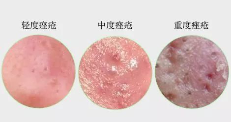 青春痘变疮了要怎么治,青春痘痤疮治疗医院