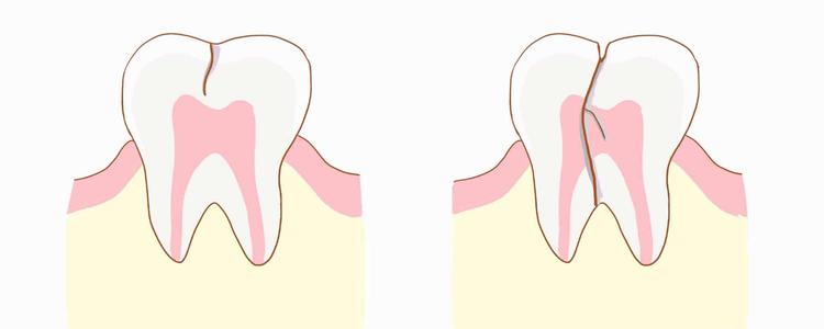 溃疡和蛀牙牙痛的区别,一咬就感觉牙里面疼怎么回事