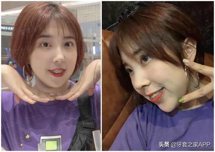 不靠整容怎么改变下巴后缩?看这里