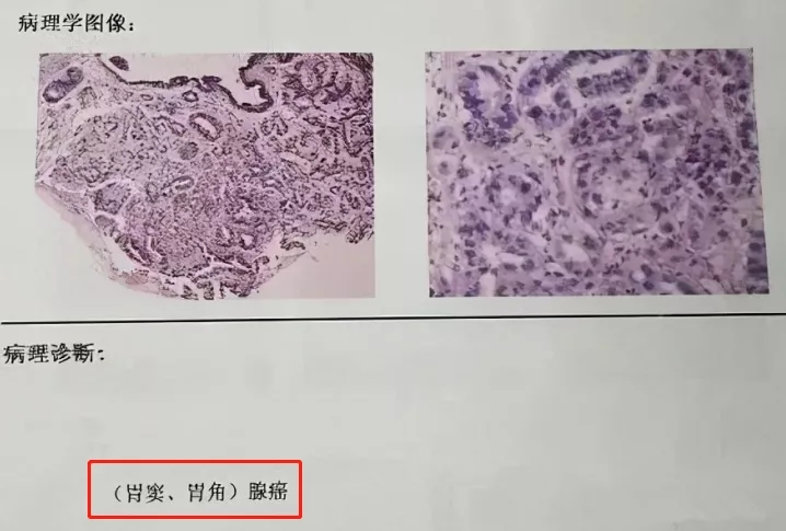 中山医院治带状疱疹,中山带状疱疹