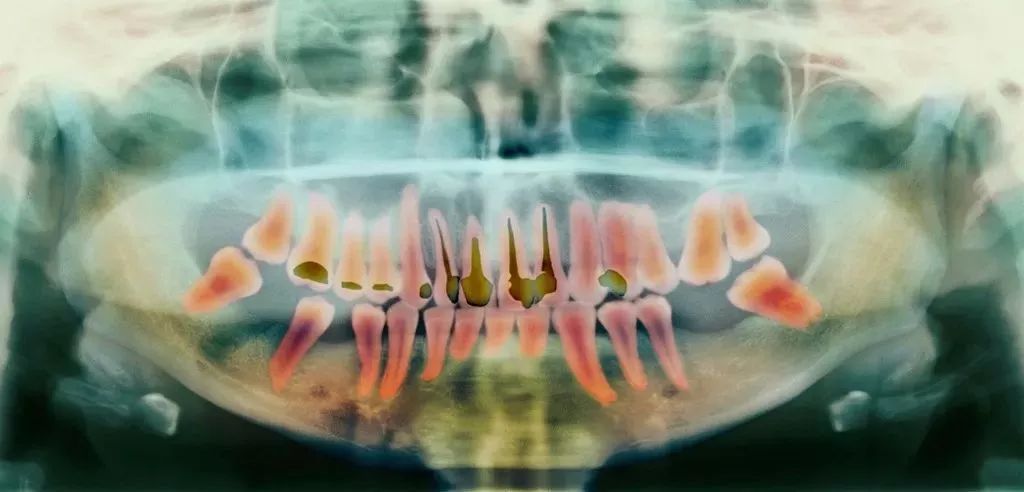 不进行根管治疗就补牙会怎么样,补牙杀神经和根管治疗是一回事吗