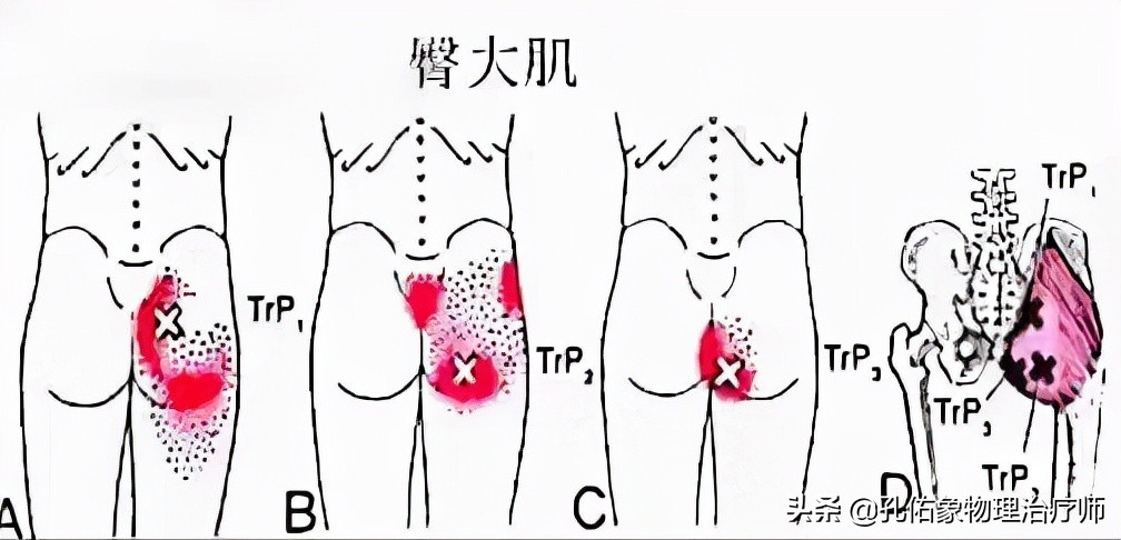臀部疼痛腿麻怎么治疗效果好,臀部腰疼痛怎么回事