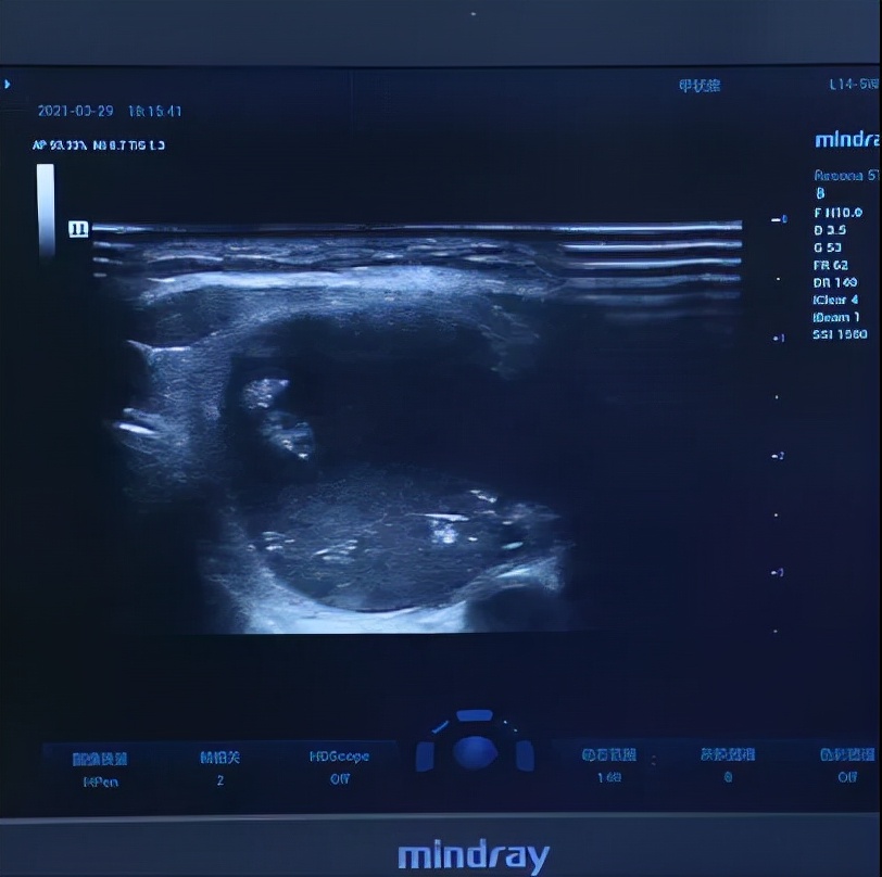 甲亢治愈的真实例子,甲亢用药过量导致甲减脖子粗