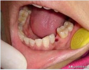 智齿牙龈肿痛下颌淋巴结肿痛,智齿肿痛是怎么回事