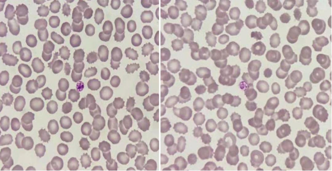 是谁揭开了血小板减少的面纱?