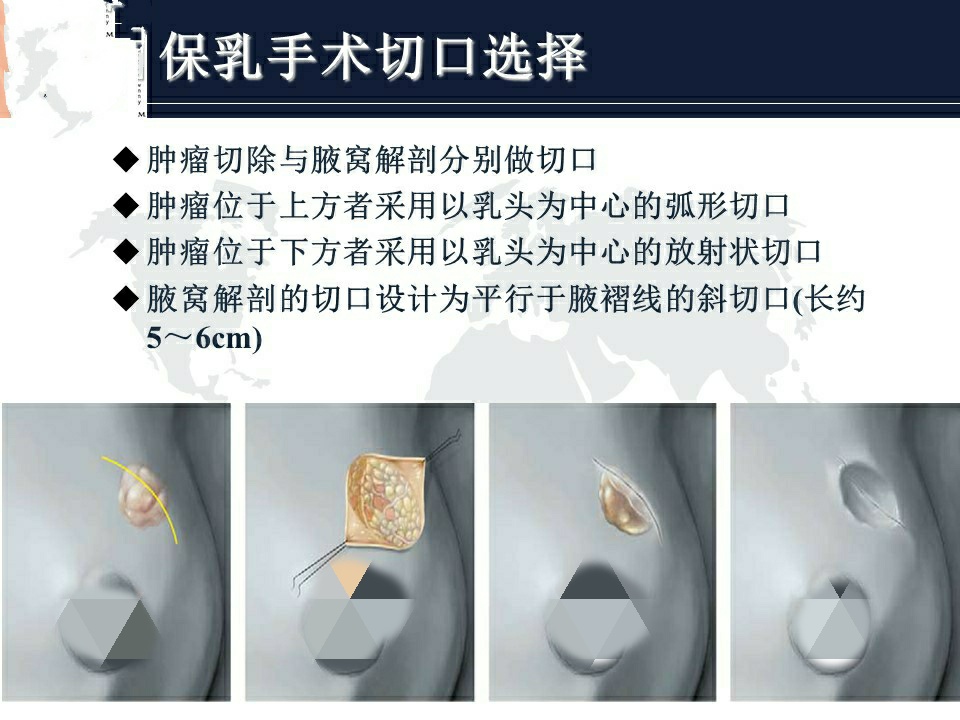 乳腺癌保乳指南,2022乳腺癌指南tnbc