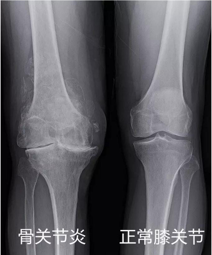 老年膝关节痛打什么针,老年人膝关节疼痛该换关节吗