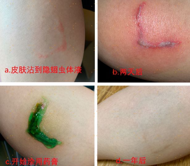 毒蚂蚁隐翅虫,被有翅膀的蚂蚁蛰了有毒吗