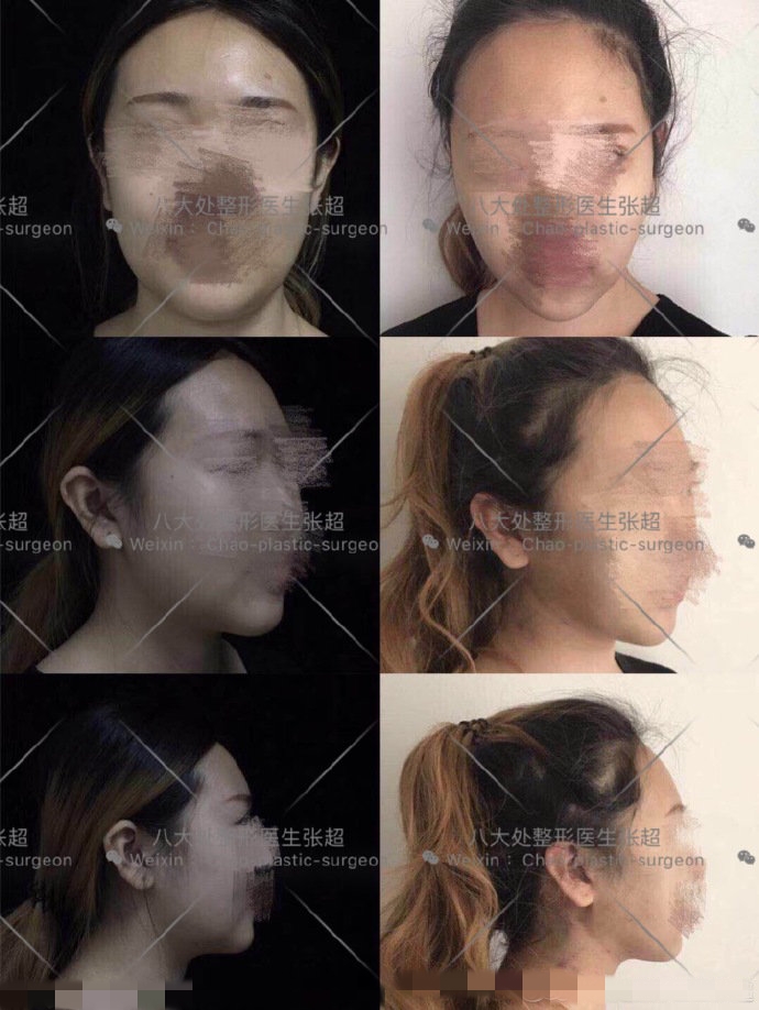 八大处整形张超,八大处张超最新视频