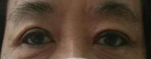 眼整形修复权威科普,科普眼整形手术是个什么手术多图