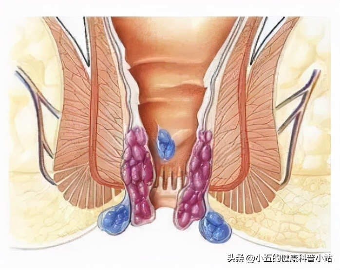 得了痔疮的人平时应该如何护理?除药物和手术治疗外还需注意6点