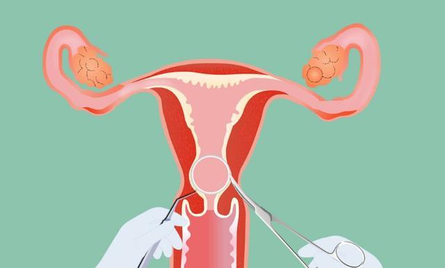 不适合上环该怎么避孕,如果不能上环应该怎么避孕