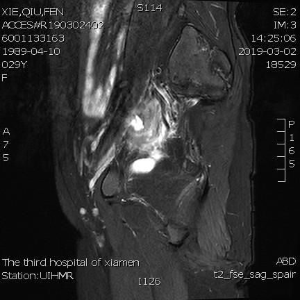 子宫腺肌症「不死的癌症」——介入栓塞来帮忙